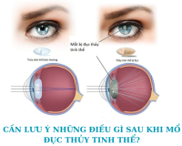 CẦN LƯU Ý NHỮNG ĐIỀU GÌ SAU KHI MỔ ĐỤC THỦY TINH THỂ?